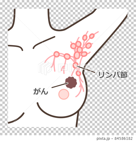 Sentinel lymph node biopsy commentary illustration 84586182