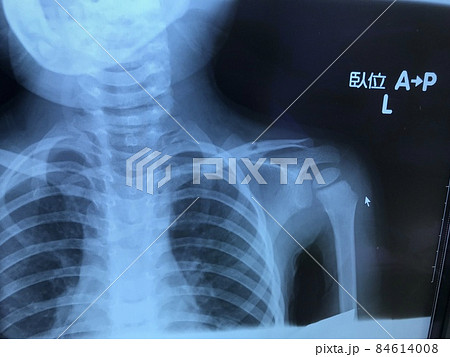 ベッドから落ちて鎖骨骨折した三歳の子供のレントゲンの写真素材 ベッドから落ちて鎖骨骨折した三歳の子供のレントゲンの写真素材