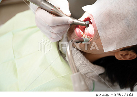 むし歯を削って治療するところ むし歯を削って治療するところ 84657232