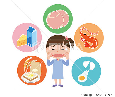 食物アレルギーで蕁麻疹が出る女の子 食物アレルギーで蕁麻疹が出る女の子 84713197