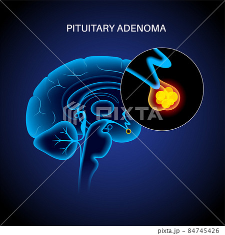 Pituitary adenoma cancer 84745426