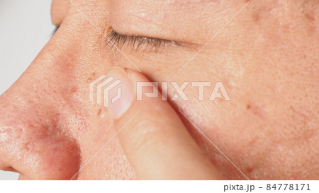 Wart on face. Macro shot of wart near eye. Papilloma on skin around eye nose and neck. Close up of birthmark Papilla or mole on skin. small hard. benign growth on the skin. caused by virus. skincare. Wart on face. Macro shot of wart near eye. Papilloma on skin around eye nose and neck. Close up of birthmark Papilla or mole on skin. small hard. benign growth on the skin. caused by virus. skincare. 84778171