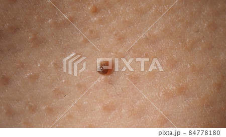 Wart on face. Macro shot of wart near eye. Papilloma on skin around eye nose and neck. Close up of birthmark Papilla or mole on skin. small hard. benign growth on the skin. caused by virus. skincare. Wart on face. Macro shot of wart near eye. Papilloma on skin around eye nose and neck. Close up of birthmark Papilla or mole on skin. small hard. benign growth on the skin. caused by virus. skincare. 84778180