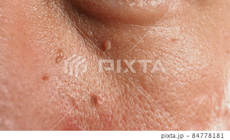 Wart on face. Macro shot of wart near eye. Papilloma on skin around eye nose and neck. Close up of birthmark Papilla or mole on skin. small hard. benign growth on the skin. caused by virus. skincare. Wart on face. Macro shot of wart near eye. Papilloma on skin around eye nose and neck. Close up of birthmark Papilla or mole on skin. small hard. benign growth on the skin. caused by virus. skincare. 84778181