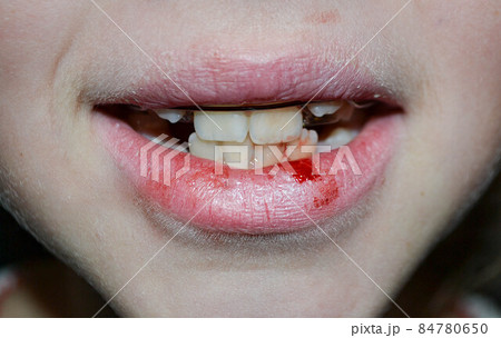 Dry and damaged lips of a girl Dry and damaged lips of a girl 84780650