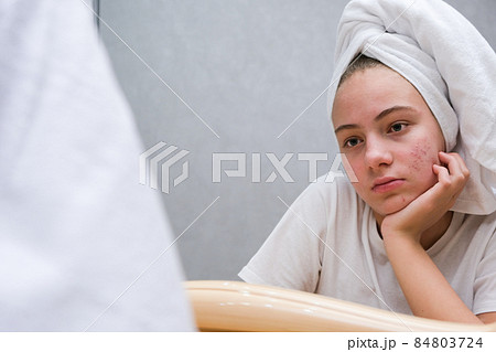 Acne. A sad teenage girl. Problematic skin in adolescents. Acne. A sad teenage girl. Problematic skin in adolescents. 84803724
