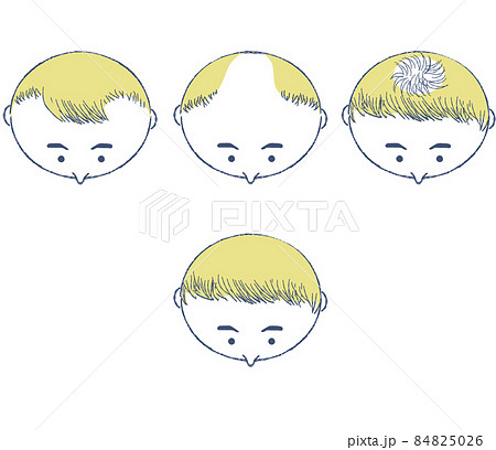薄毛の種類と治療改善後のイラスト 薄毛の種類と治療改善後のイラスト 84825026