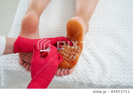 The doctor makes intramuscular injections of botulinum toxinon in female feet against hyperhidrosis, excessive sweating The doctor makes intramuscular injections of botulinum toxinon in female feet against hyperhidrosis, excessive sweating 84853751