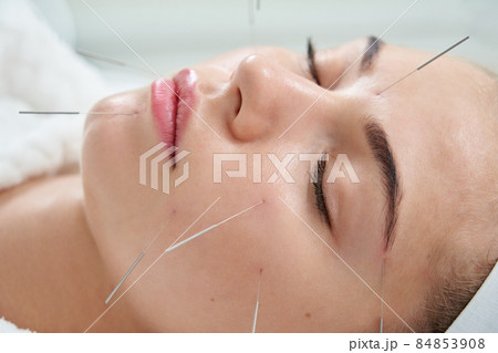 Young woman having an acupuncture treatment therapy on her face in spa salon. Alternative medicine and therapy concept Young woman having an acupuncture treatment therapy on her face in spa salon. Alternative medicine and therapy concept 84853908