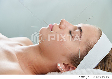 Young woman having an acupuncture treatment therapy on her face in spa salon. Alternative medicine and therapy concept Young woman having an acupuncture treatment therapy on her face in spa salon. Alternative medicine and therapy concept 84853945
