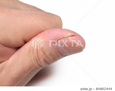 爪のきわの裂け目 爪のきわの裂け目 84862444