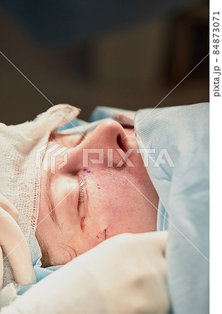 Close up of the face of a patient who is undergoing blepharoplasty. The surgeon cuts the eyelid and performs manipulations using medical instruments 84873071
