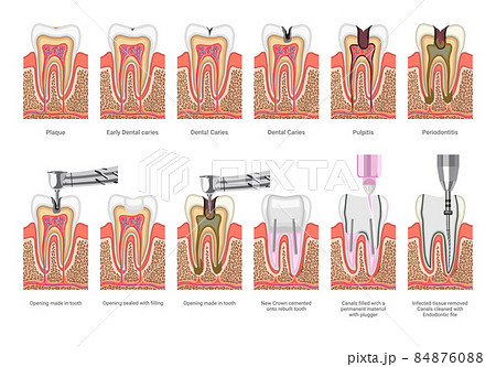 Dental Caries and Treatment Illustrations 84876088