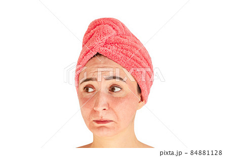 Face with skin irritation, acne, rash or sunburn Face with skin irritation, acne, rash or sunburn 84881128
