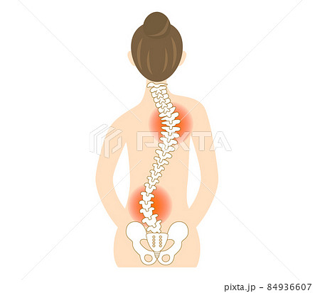側弯症 背骨が曲がった女性の背中のイラストのイラスト素材