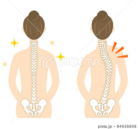 側弯症 背骨が曲がった女性の背中のイラストのイラスト素材