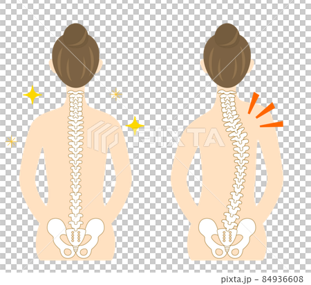 側弯症、背骨が曲がった女性の背中のイラスト 側弯症、背骨が曲がった女性の背中のイラスト 84936608