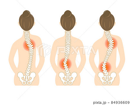 側弯症、背骨が曲がった女性の背中のイラスト 84936609