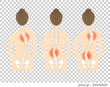 側弯症、背骨が曲がった女性の背中のイラスト 84936609