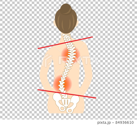 側弯症、背骨が曲がった女性の背中のイラスト 側弯症、背骨が曲がった女性の背中のイラスト 84936610