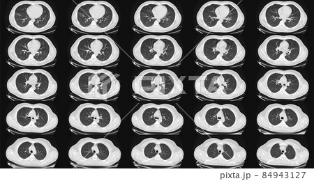 Computed tomography of the lungs in a healthy adult man. Normal lungs ct scan. May be part of COVID-19 diagnostic. 84943127