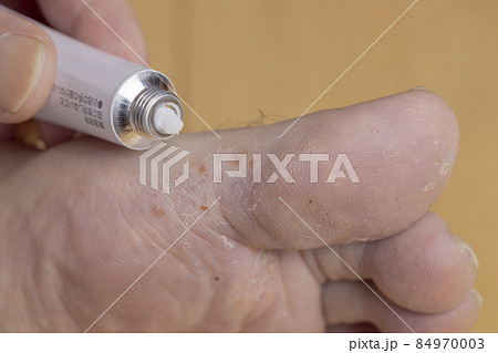 足裏の水虫と塗り薬 84970003