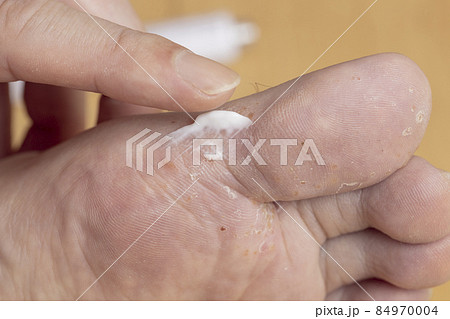 足裏の水虫と塗り薬 足裏の水虫と塗り薬 84970004
