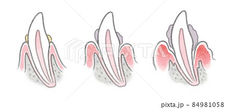 犬の歯周病の進行を説明した歯の構造イラスト 犬の歯周病の進行を説明した歯の構造イラスト 84981058