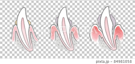 解釋犬牙周病進展的牙齒結構圖 84981058