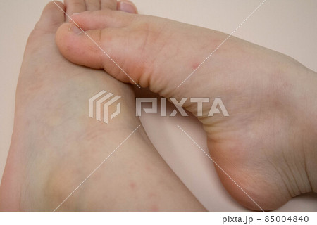 写真素材：手足口病の子どもの足 85004840