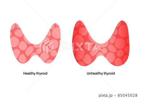 thyroid gland disease 85045028