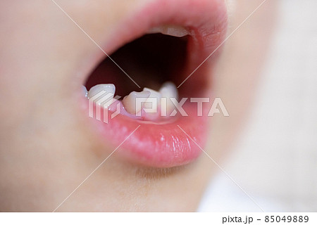 ぐらつく子供の前歯(乳歯) ぐらつく子供の前歯(乳歯) 85049889