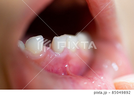 ぐらつく子供の前歯（乳歯） 85049892