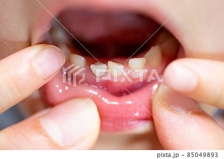 ぐらつく子供の前歯（乳歯） 85049893