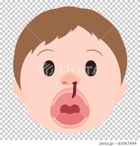 唇裂和腭裂的插圖_單側唇裂和腭裂_面部_開口 85067494