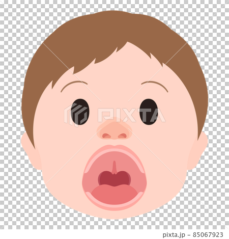 口唇口蓋裂_粘膜下口蓋裂のイラスト_顔_開口 85067923