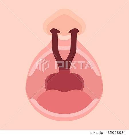口唇口蓋裂_両側性唇顎口蓋裂のイラスト_アップ 口唇口蓋裂_両側性唇顎口蓋裂のイラスト_アップ 85068084
