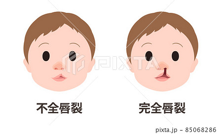 口唇口蓋裂_不全唇裂と完全唇裂のイラスト_顔 85068286