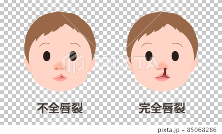 口唇口蓋裂_不全唇裂と完全唇裂のイラスト_顔 85068286