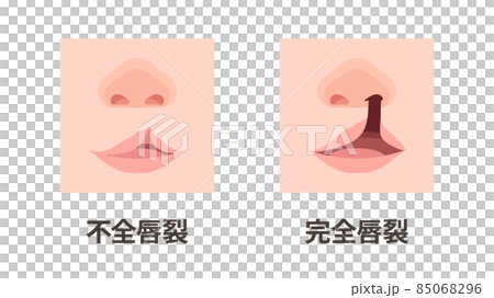 唇裂和腭裂_不完全和完全裂唇的圖示_up 唇裂和腭裂_不完全和完全裂唇的圖示_up 85068296