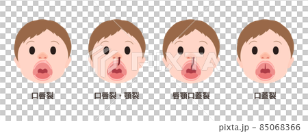 開封時的唇裂、腭裂、腭裂示意圖 開封時的唇裂、腭裂、腭裂示意圖 85068366