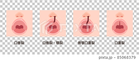 Illustration of cleft lip, palate, and cleft palate at the time of opening 85068379