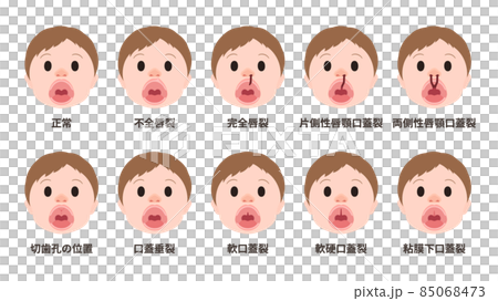 唇齶裂類型的插圖 唇齶裂類型的插圖 85068473