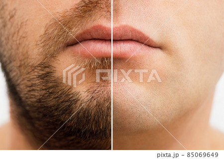 Close up photo of a man's face before and after shaving. a young man with a beard. Comparison of a man's face with a beard and without a beard. use of aftershave cream. Close up photo of a man's face before and after shaving. a young man with a beard. Comparison of a man's face with a beard and without a beard. use of aftershave cream. 85069649