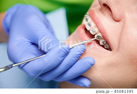 Close up of dentist hand using dental forceps while putting orthodontic braces on female patient teeth. Woman having dental procedure in clinic. Concept of dentistry and orthodontic treatment. 85081395