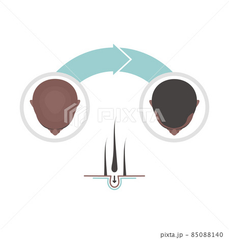 Hair transplantation in men medical illustration design 85088140