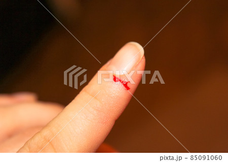 Blood protrudes from a small cut wound, maim on the index finger of a woman's hand. Damage to epidermis, skin on body. Bleeding injured fingers, hands palm. An accidence, life insurance. Feel pain. Blood protrudes from a small cut wound, maim on the index finger of a woman's hand. Damage to epidermis, skin on body. Bleeding injured fingers, hands palm. An accidence, life insurance. Feel pain. 85091060