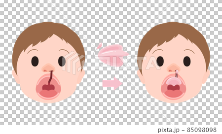 Cleft lip and palate_Hots Floor wearing illustration_Hotz Floor_NAM available 85098098