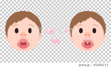 口唇口蓋裂_バルブ型スピーチエイドを装着するイラスト_構音障害 85098213