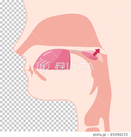 口唇口蓋裂_パラタルリフトを装着した矢状断のイラスト_軟口蓋挙上装置 口唇口蓋裂_パラタルリフトを装着した矢状断のイラスト_軟口蓋挙上装置 85098233